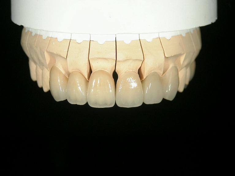 当院の審美歯科ではオールセラミッククラウン（e-max）を取り扱っています。