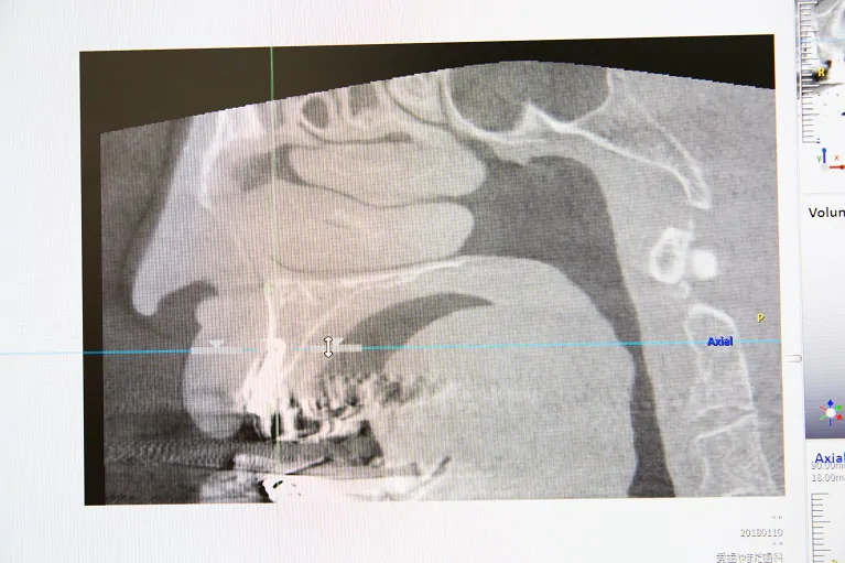 梅田でインプラント治療を行う当院ではCTを完備しています