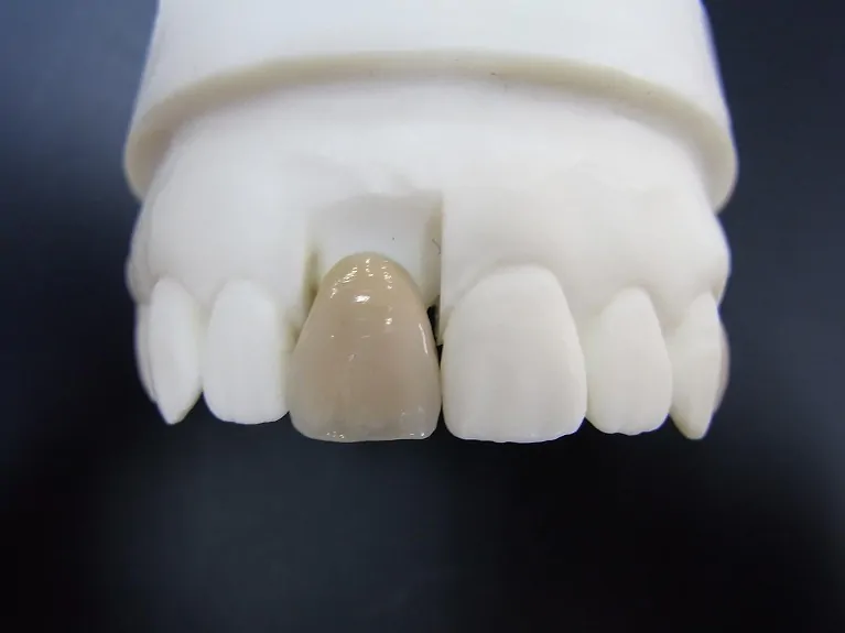 当院の審美歯科ではメタルボンドを取り扱っています。